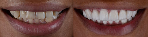 Before and After Dental Photo Before and After Dental Photo